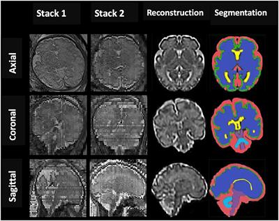 Quantification of Intracranial Structures Volume in Fetuses Using 3-D Volumetric MRI: Normal Values at 19 to 37 Weeks' Gestation